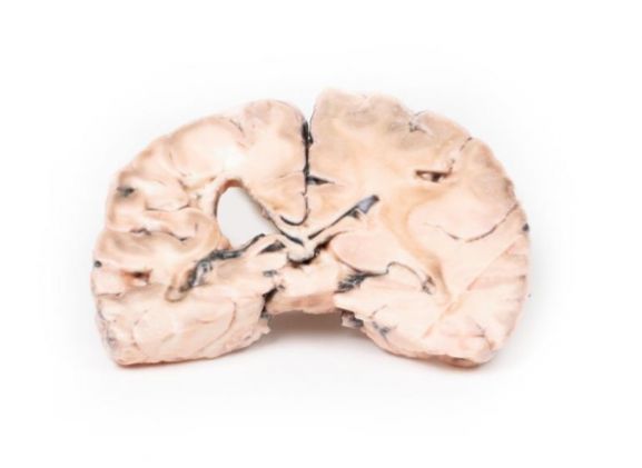 https://www.jayakelana.id.202-10-43-6.cpanel.site/uploads/product/-mp2005-left-cerebral-infarct-79391d7c5ffe427_cover.jpg
